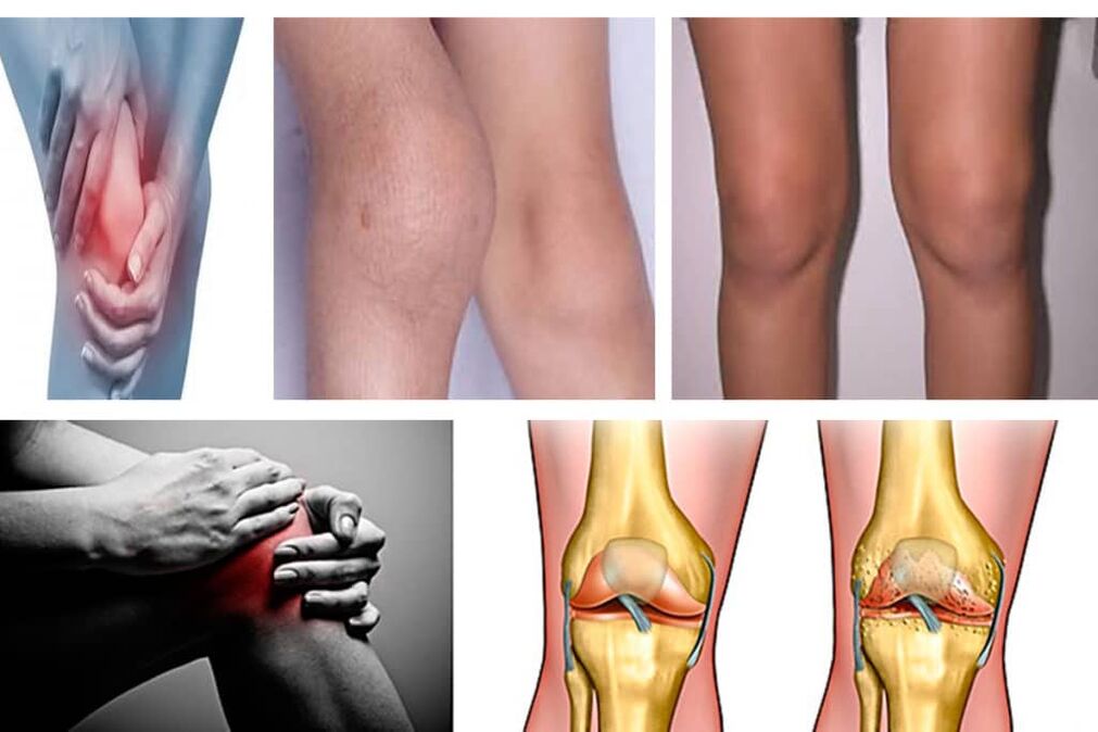 Symptoms Knee Arthrosis